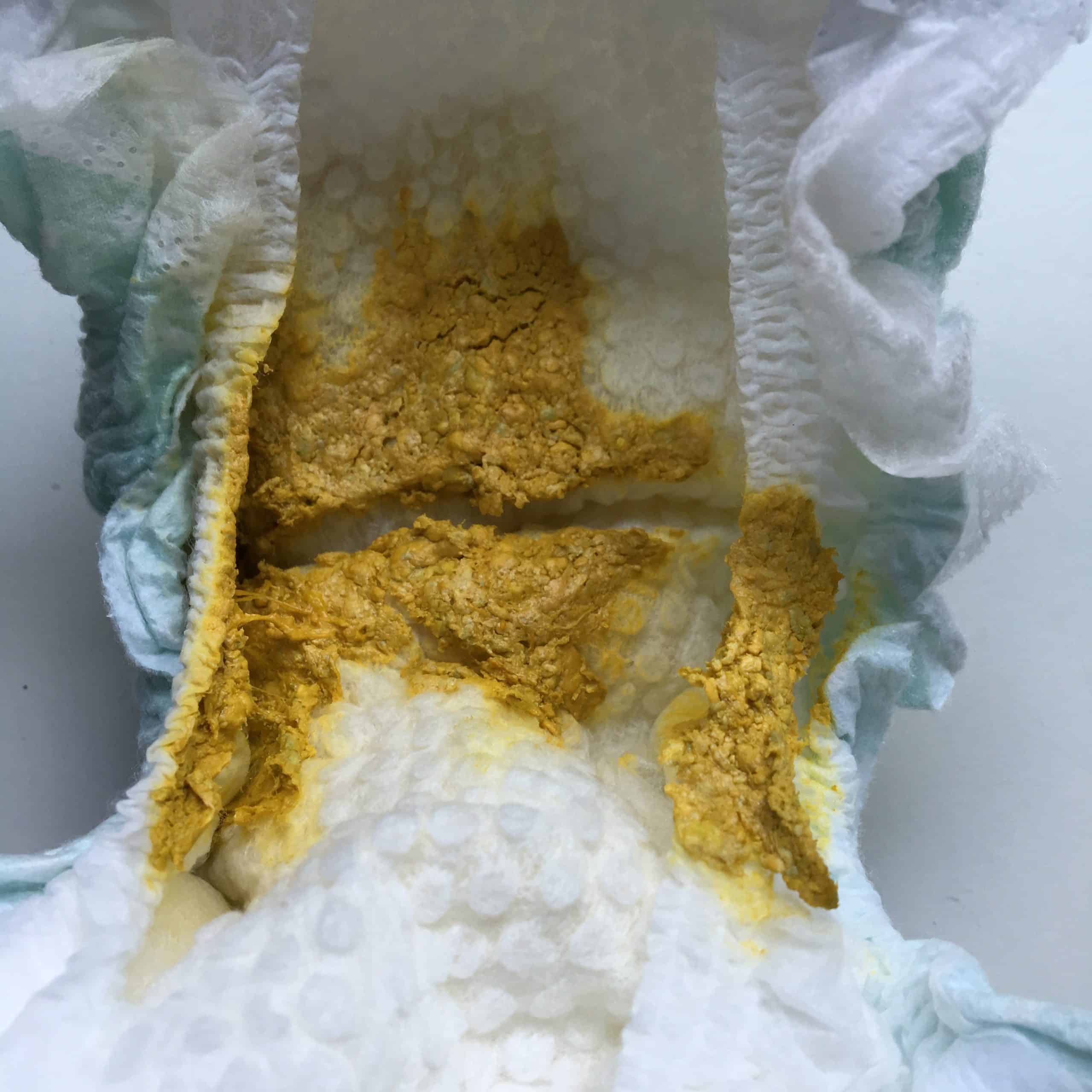 What does cystic fibrosis baby poop look like â Oaftgx