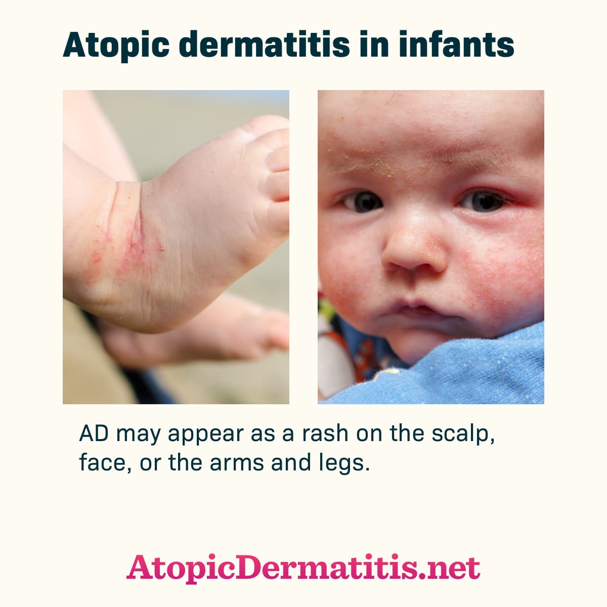 What is Atopic Dermatitis or Atopic Eczema?