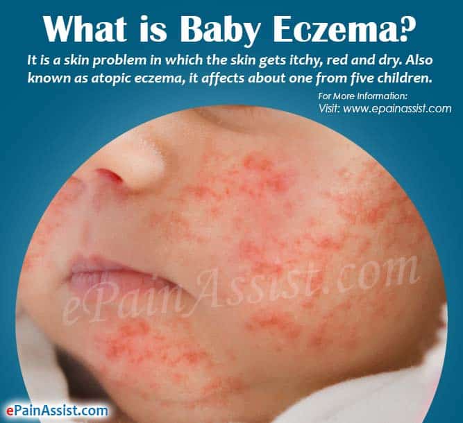 What is Baby Eczema