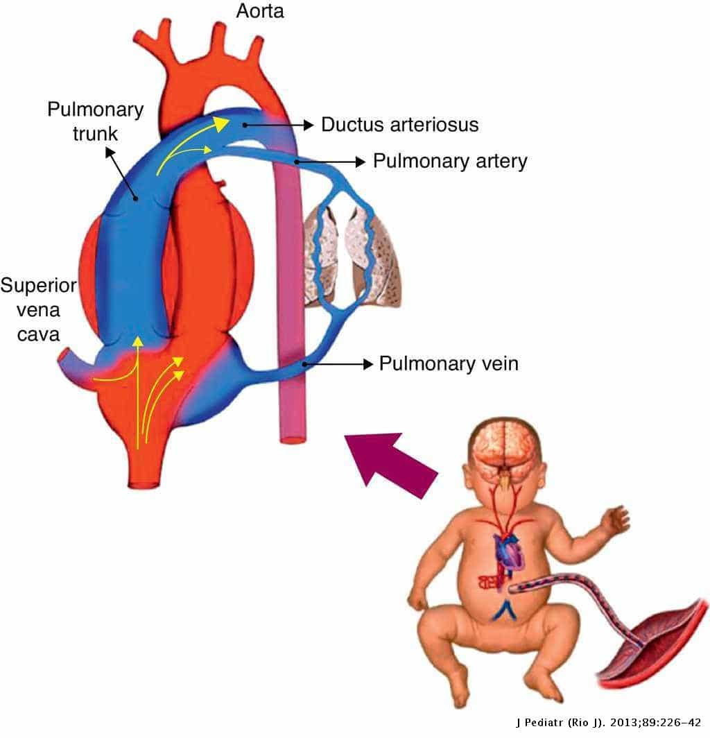 what is pulmonary hypertension in newborns â Bnr.Co