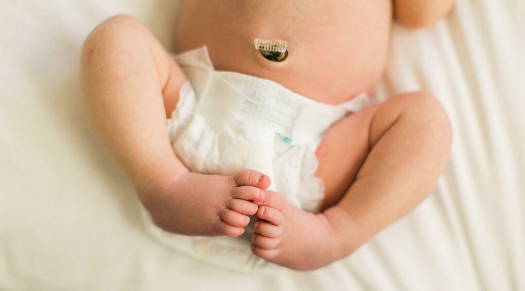 What to do when babys umbilical cord falls off