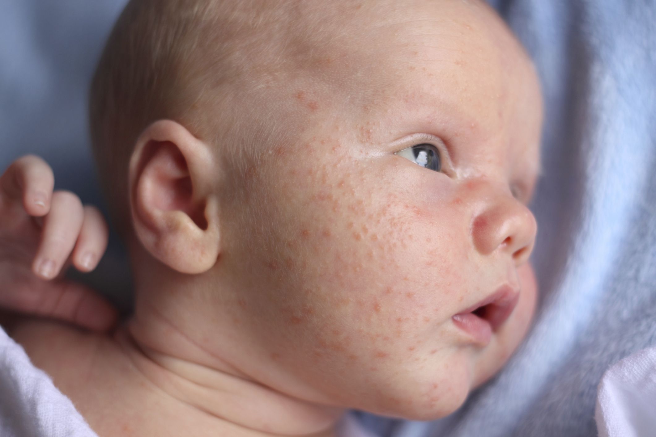 Why does my baby get pimples?