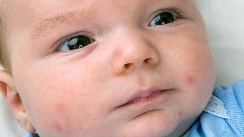 Why Does My Baby Have Acne?